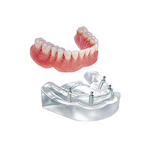 overdenture dental implant