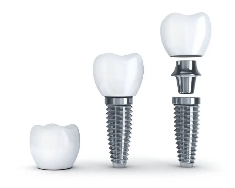 titanium tooth